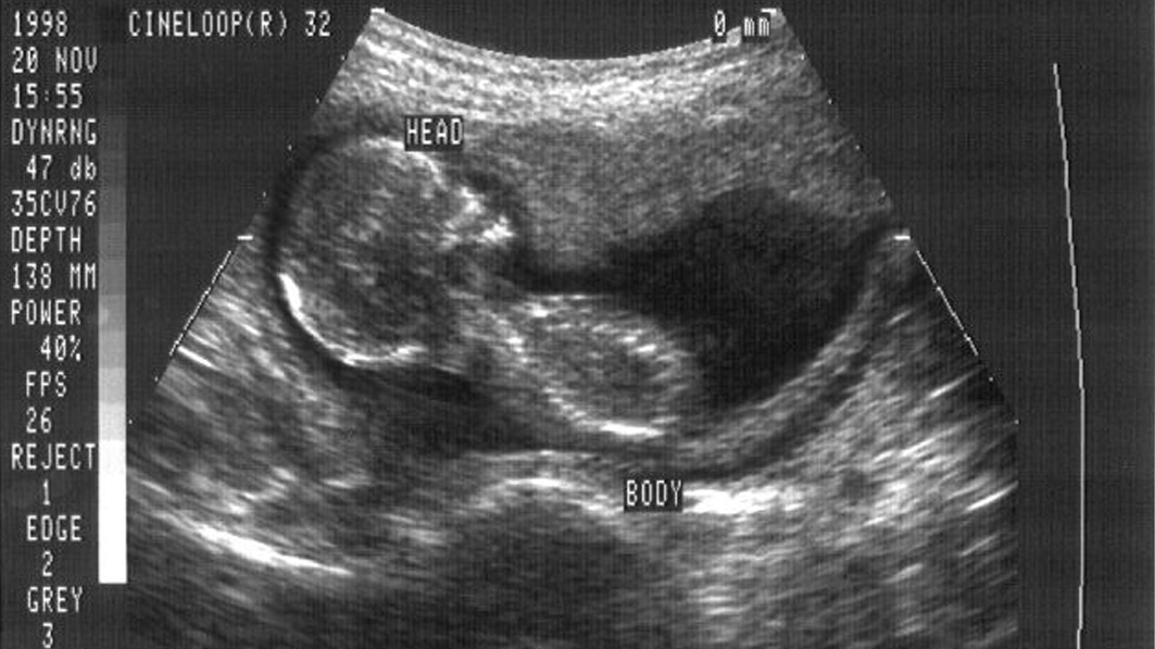 Proof that Indiana’s Ultrasound Law is an Effective Way to Save Unborn Lives