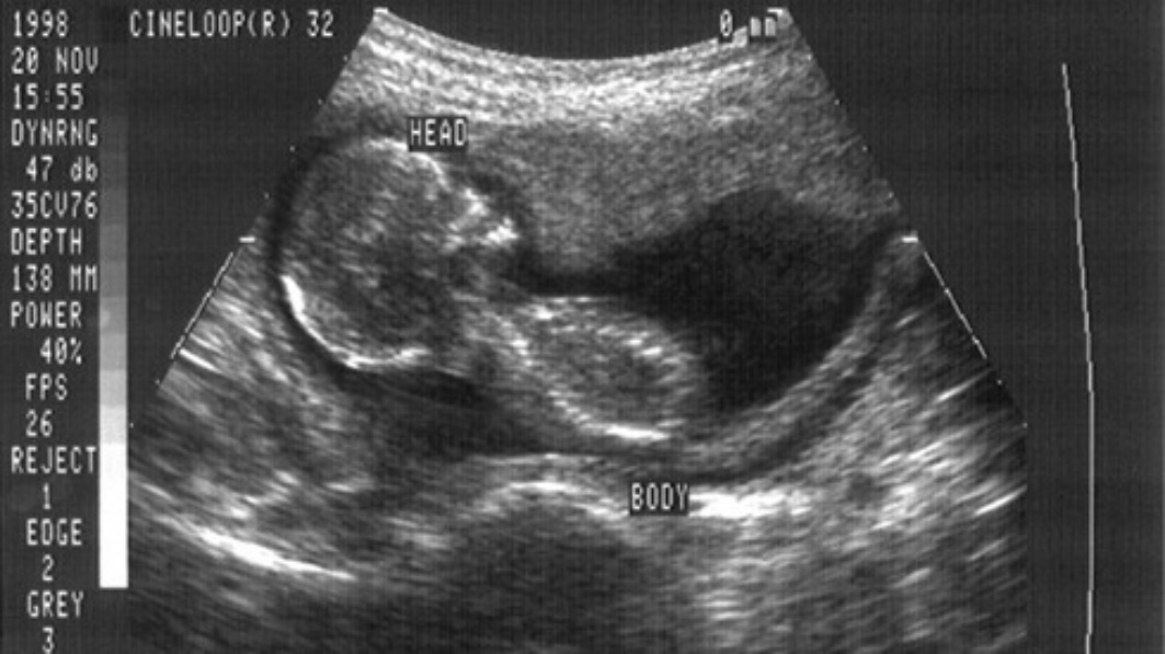 Ultrasound Laws are Constitutional, Says U.S. Appeals Court