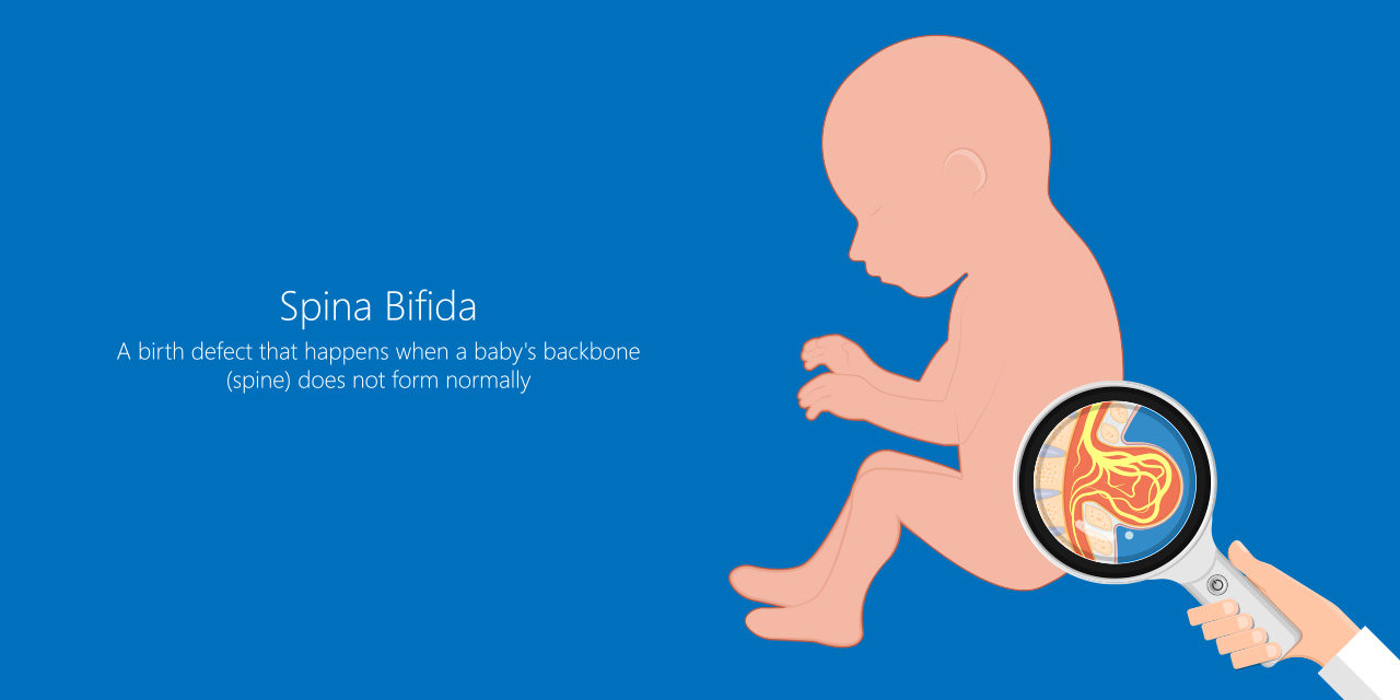 Surgery on Preborn Babies with Spina Bifida Saves Lives and Prevents Paralysis