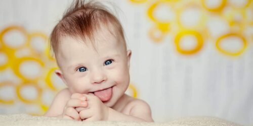 Baby with Down Syndrome