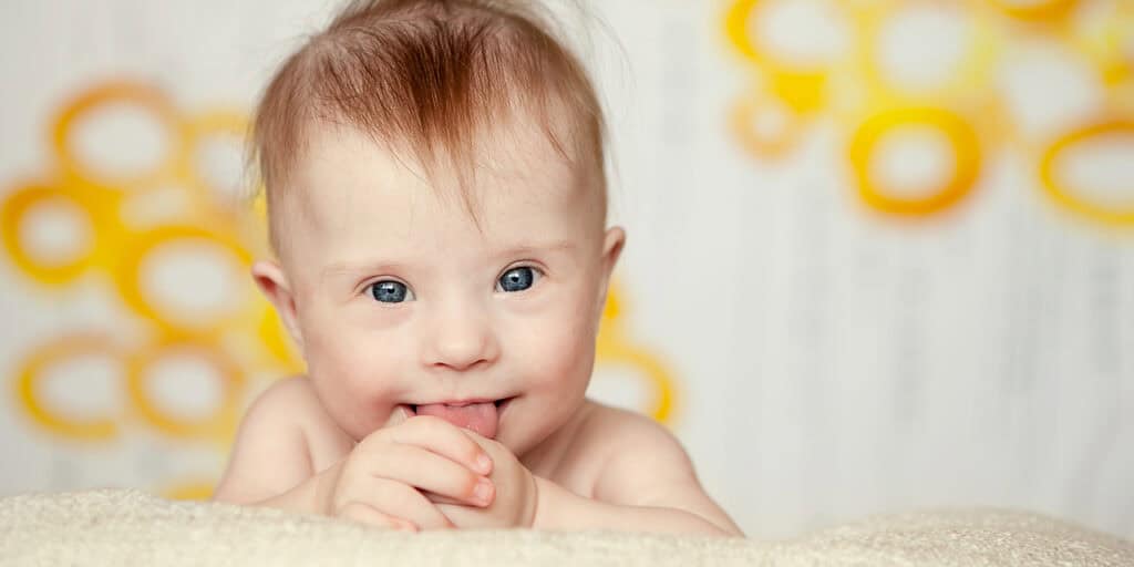 Down Syndrome baby