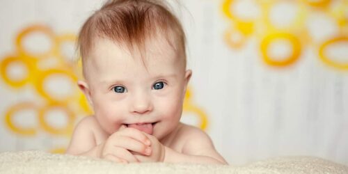 Down Syndrome baby