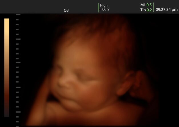 Baby on Ultrasound